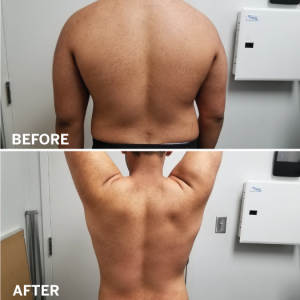 Cameron’s Back Pain is Gone!